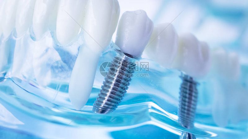烤瓷牙冠与全瓷牙冠：材质差异与适用场景解析**