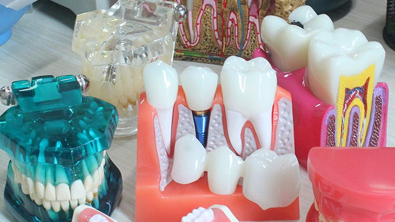 种植牙与假牙：使用寿命揭秘与保养攻略